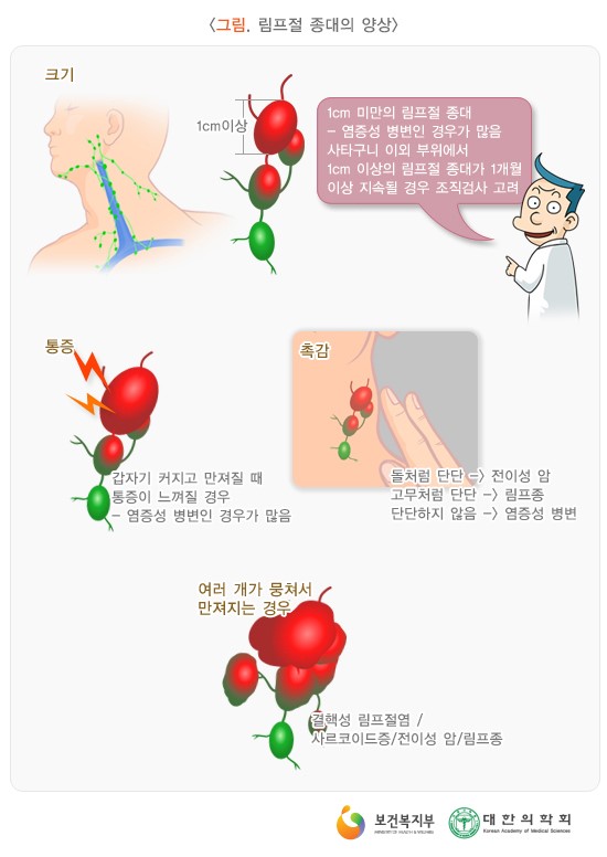 림프절염, 임파선 비대 : 네이버 블로그