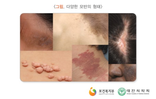 다양한 모반의 형태