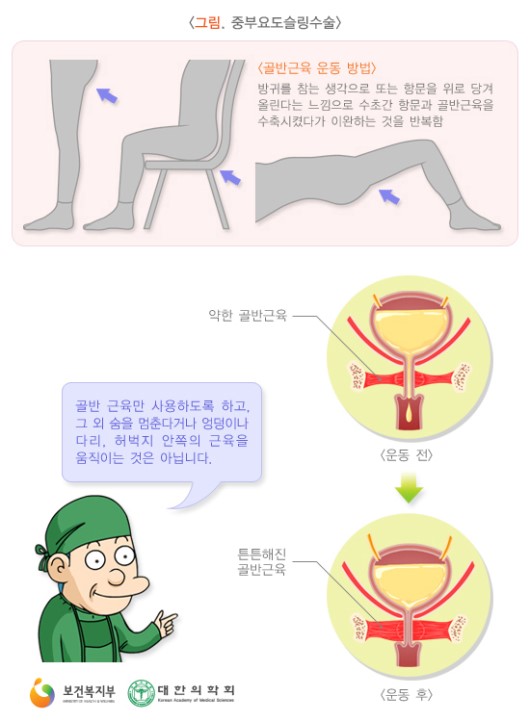 요실금 예방을 위한 골반근육운동 방법