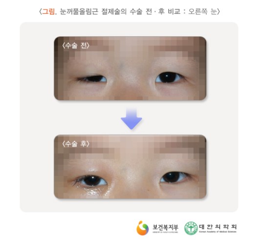 눈꺼풀올림근 절제술의 수술 전-후 비교 (오른쪽 눈)