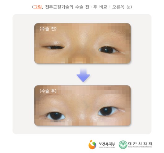 전두근걸기술의 수술 전-후 비교 (오른쪽 눈)