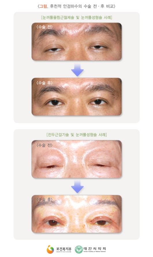 후천적 안검하수의 수술 전-후 비교