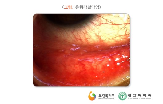 유행각결막염