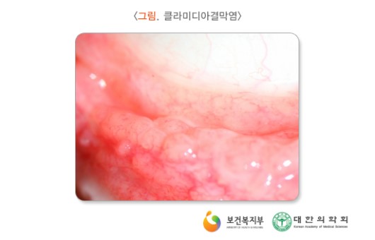 클라미디아결막염