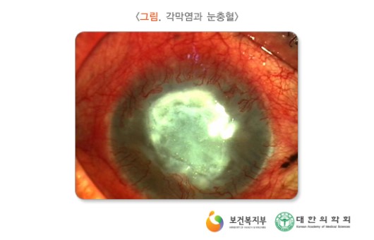각막염과 눈충혈