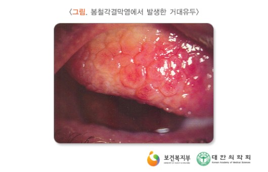 봄철각결막염에서 발생한 거대유두