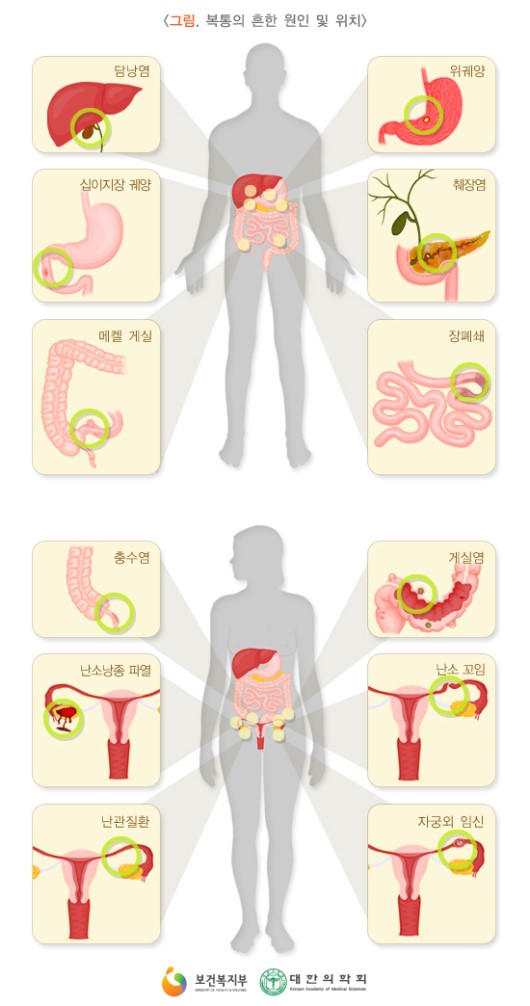 복통의 흔한 원인 및 위치