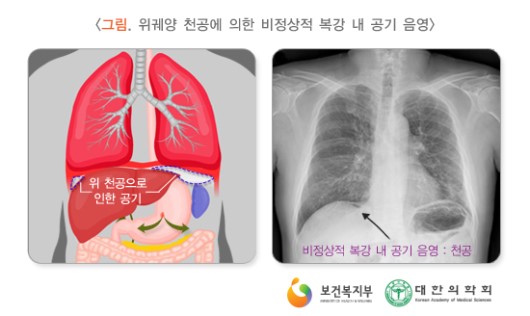 위궤양 천공에 의한 비정상적 복강 내 공기 음영