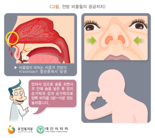 전방 비출혈의 응급처치