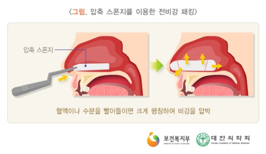 압축 스폰지를 이용한 전비강 패킹