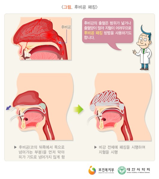 후비공 패킹