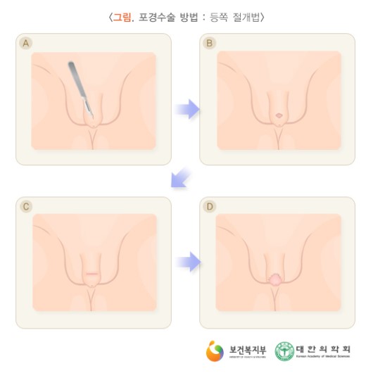 포경수술 방법 : 등쪽 절개법
