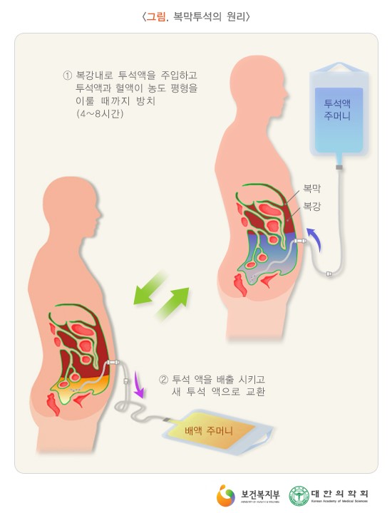 투석 간호 (CRRT + 혈액투석 + 복막투석) : 네이버 블로그