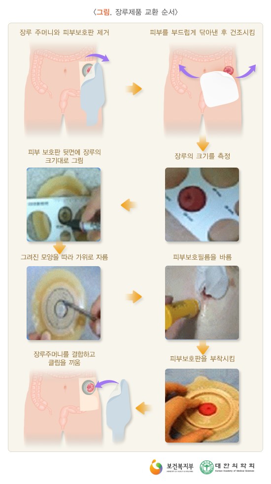 장루 및 장루 관리 : 네이버 블로그