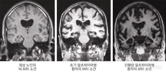 ¾ËÃ÷ÇÏÀ̸Ӻ´ MRI ¿µ»ó