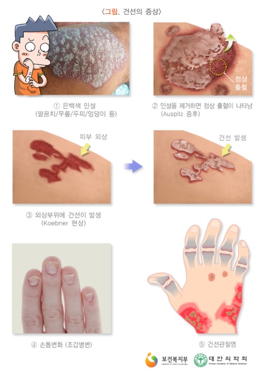건선의 증상