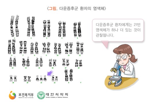 다운증후군 환자의 염색체