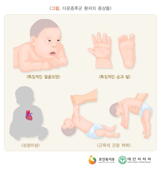다운증후군 환자의 증상들