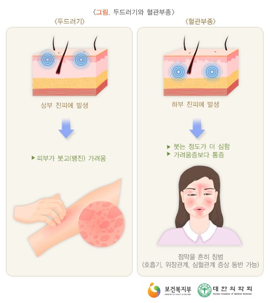 두드러기와 혈관부종