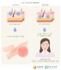 두드러기와 혈관부종
