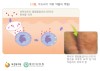 두드러기 치료 약물의 역할