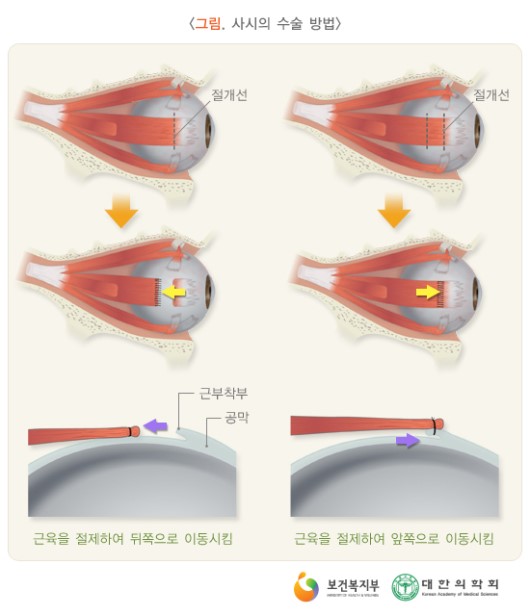 사시의 수술 방법