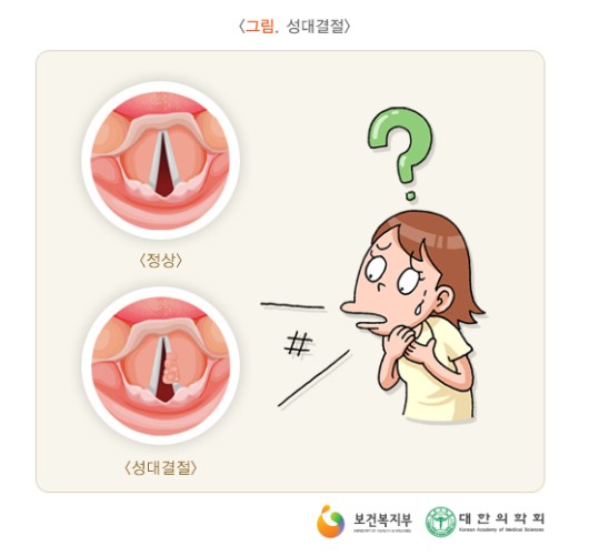 성대결절