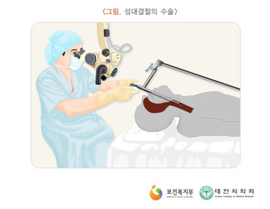 성대결절의 수술적 치료