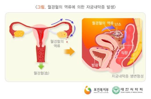월경혈의 역류에 의한 자궁내막증 발생