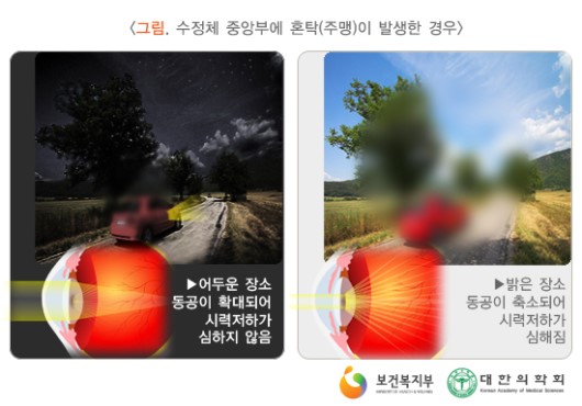 수정체 중앙부에 혼탁이 발생한 경우