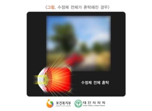 수정체 전체가 혼탁해진 경우