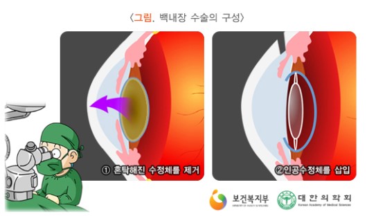 백내장 수술의 구성