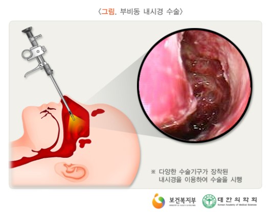 부비동 내시경 수술