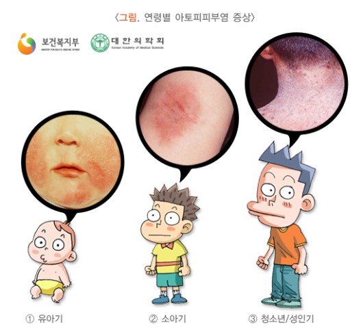 연령별 아토피피부염 증상
