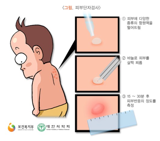 피부단자검사