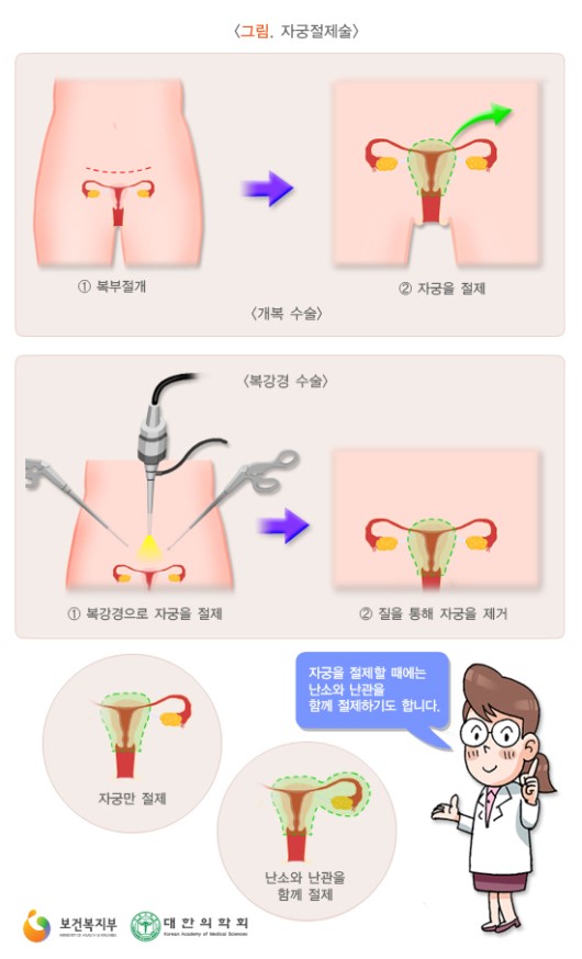 자궁절제술
