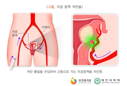 자궁 동맥 색전술
