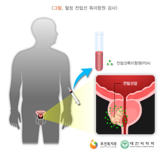 혈청 전립선 특이항원 검사