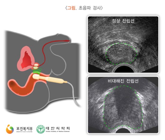 초음파 검사