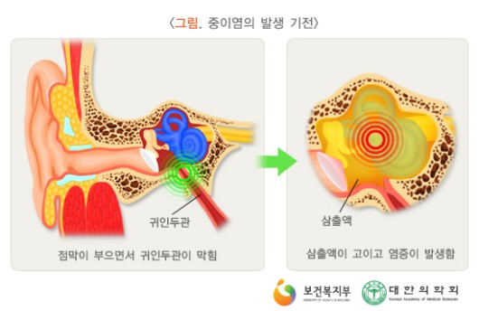 중이염의 발생 기전