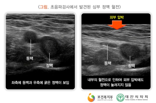 초음파검사에서 발견된 심부 정맥 혈전