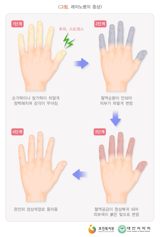 레이노병 - 레이노병의 증상