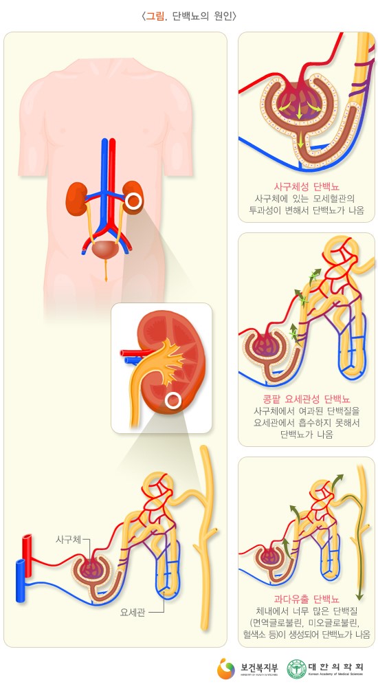 소변 검사 (Urinalysis) + 소변 이상 (혈뇨, 단백뇨, 당뇨, 농뇨) : 네이버 블로그