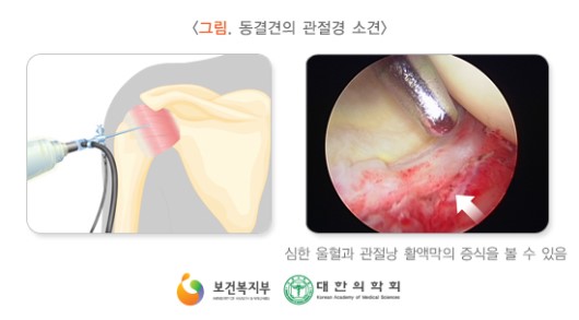 동결견의 관절경 소견