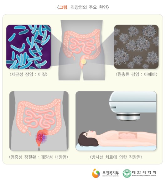 직장염의 주요 원인