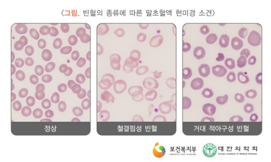 빈혈의 종류에 따른 말초혈액 현미경 소견
