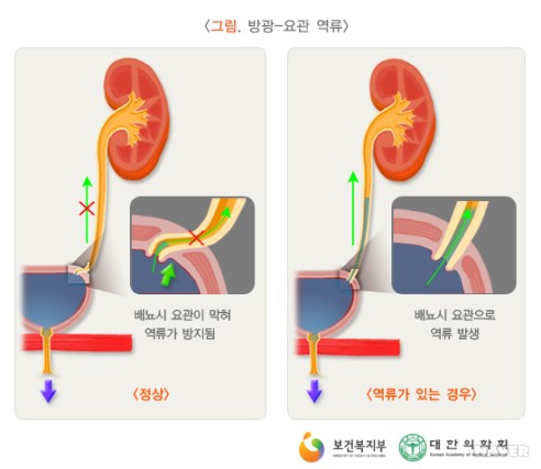 요로감염 : 네이버 블로그