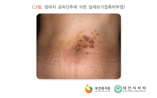 청바지 금속단추에 의한 알레르기접촉피부염