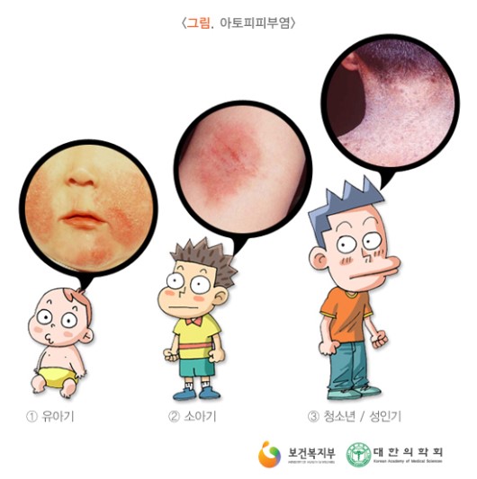 아토피피부염