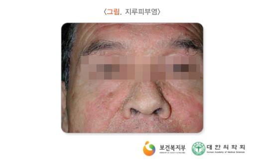 지루피부염